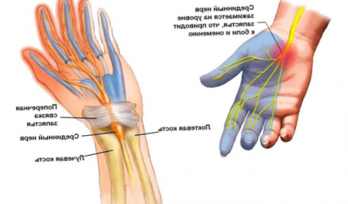 Немеет кисть левой руки